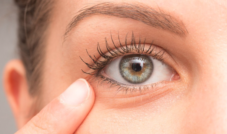 Everything You Need to Know About Eyeball Wrinkle